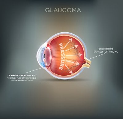 Causes Of Glaucoma